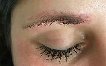 Resuelto caso de microblading con la técnica avanzada de micropigmentación. Más duradera y natural.